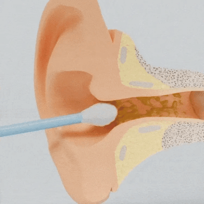 EarClean - Rengöring av öronvax